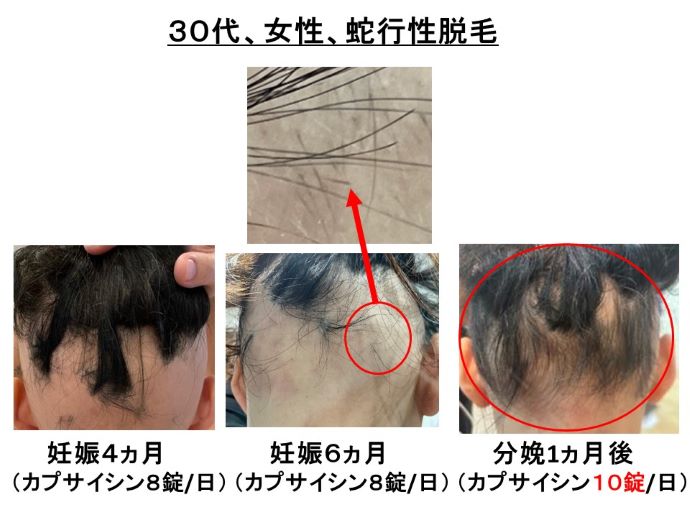 円形脱毛症　病院